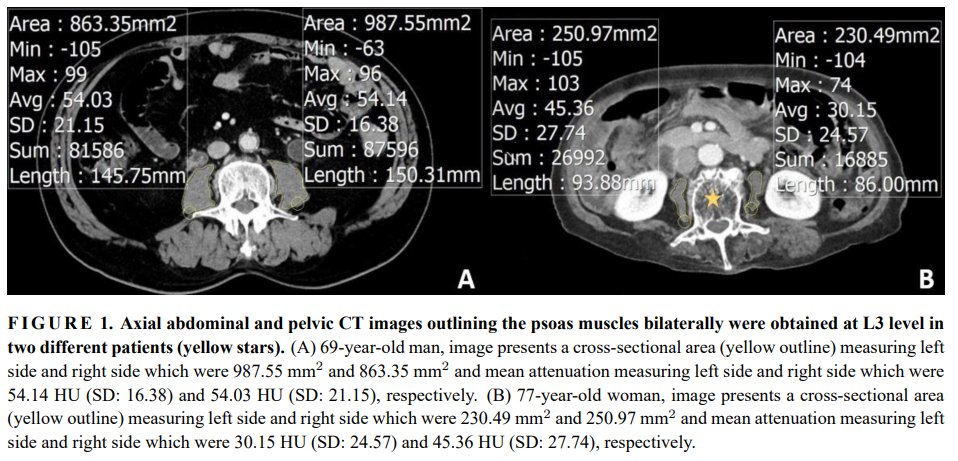 MRE_signavitae's tweet photo. 【Article Title】“Measurement of psoas muscle size using existing computed tomography to predict patient outcomes in emergency departments ”
【Click】https://t.co/f8owtEKLMR
#Psoasmuscle; #Sarcopenia;#Frailelderly;#Emergencydepartments;#Computedtomography; https://t.co/1AZbyTUw6C