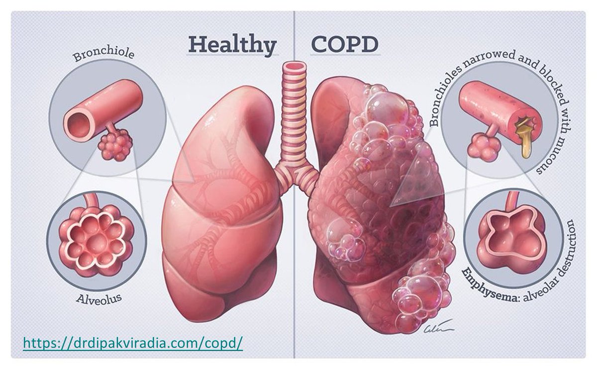 CrystecPharma's tweet photo. We’re continuing to support COPD Awareness month this week. Have a read of how Crystec can help in the rapid development of combination COPD products:

https://t.co/o8ShkIHkZe https://t.co/QaJeCfHkXf