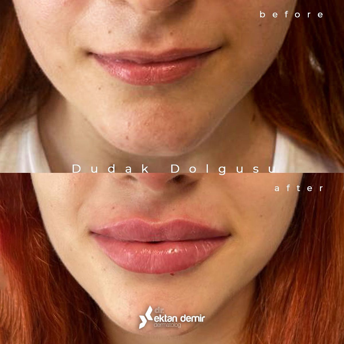 Dudak dolgusu, dudaklara hacim kazandırarak daha dolgun gözükmesi, sınırlarının belirginleşmesi, asimetrik görünümün düzeltilmesi ve yaşlanma etkisinin giderilmesi amacıyla uygulanan bir işlemdir. 👄💄
#dudakdolgu #istanbul #ataşehir #botoks #dolgu #kadın

ektandemir.com/dudak-dolgusu