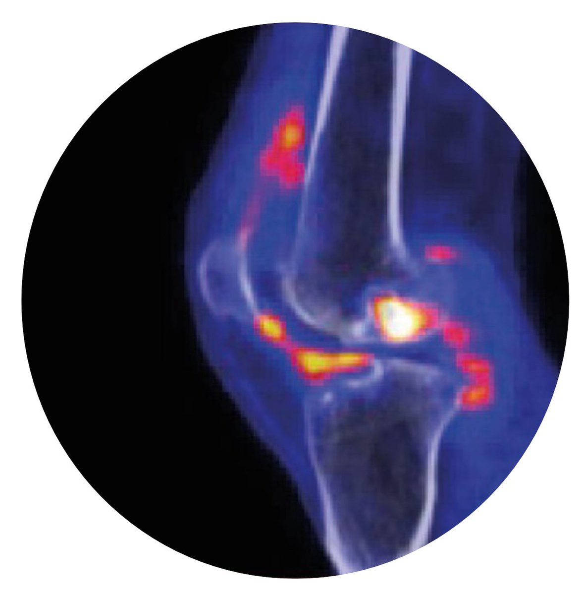 RheumJnl's tweet photo. #RheumOff Round Three!⭐
1️⃣ PET-CT image of arthritic knee joint of RA patient
https://t.co/eU6JP2huvc by @VanderKraan_Eng et al
🆚
2️⃣ Preclinical interstitial lung disease in RA patient https://t.co/WHc7lseYGA by @ea_fletcherMD @jeffsparks et al
Poll below👇 https://t.co/TSx5fGTj2s