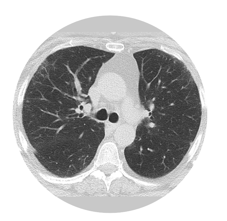 RheumJnl's tweet photo. #RheumOff Round Three!⭐
1️⃣ PET-CT image of arthritic knee joint of RA patient
https://t.co/eU6JP2huvc by @VanderKraan_Eng et al
🆚
2️⃣ Preclinical interstitial lung disease in RA patient https://t.co/WHc7lseYGA by @ea_fletcherMD @jeffsparks et al
Poll below👇 https://t.co/TSx5fGTj2s