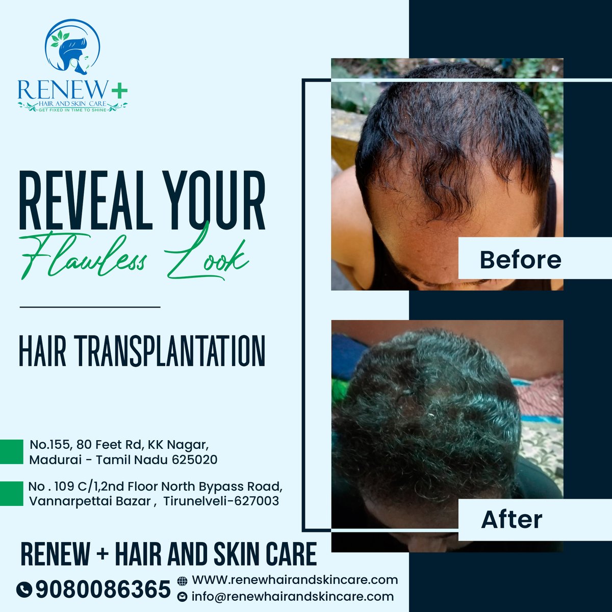 Renewplus_HS's tweet photo. Hair Treatment to Retrieve Your Natural Hair
WhatsApp: https://t.co/jrSex806cJ
Website: https://t.co/aEXYUXg0ry
#renewplushaircare #renewplus #renewhair #hairgrowth #hairtransplantation #haircare #hairtreatment #haircarecenter #skincare #Madurai #Tirunelveli #hairclinic https://t.co/iGh79BsoIM