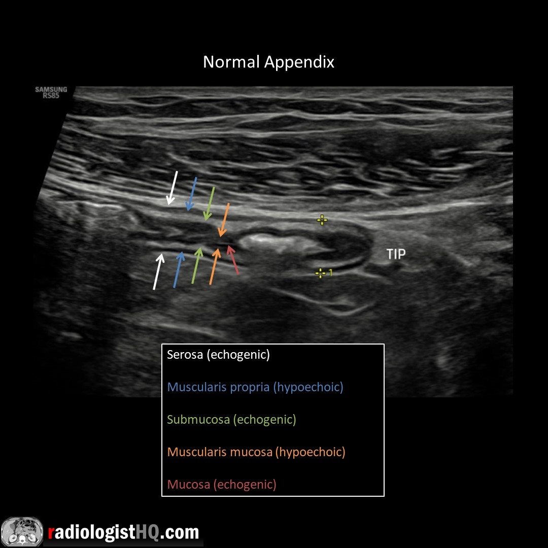Daniel Kowal, MD, RMSK | Radquarters (@radquarters) on Twitter photo Normal, blind-ending appendix on US measuring 6 mm. Outer diameter <6 mm almost always normal, 6-8 mm borderline, >8 mm highly suspicious for appendicitis. Watch 📽️ video to learn more: bit.ly/rhq-appy
<a href="/BostonImaging/">Boston Imaging</a> <a href="/SamsungHealth/">Samsung Healthcare</a> #FOAMrad #FOAMed #radres #medstudent Normal, blind-ending appendix on US measuring 6 mm. Outer diameter <6 mm almost always normal, 6-8 mm borderline, >8 mm highly suspicious for appendicitis. Watch 📽️ video to learn more: bit.ly/rhq-appy
<a href="/BostonImaging/">Boston Imaging</a> <a href="/SamsungHealth/">Samsung Healthcare</a> #FOAMrad #FOAMed #radres #medstudent