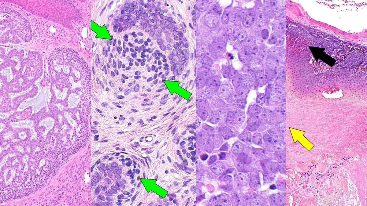 Jerad Gardner, MD on Twitter "All that is blue is not basal cell