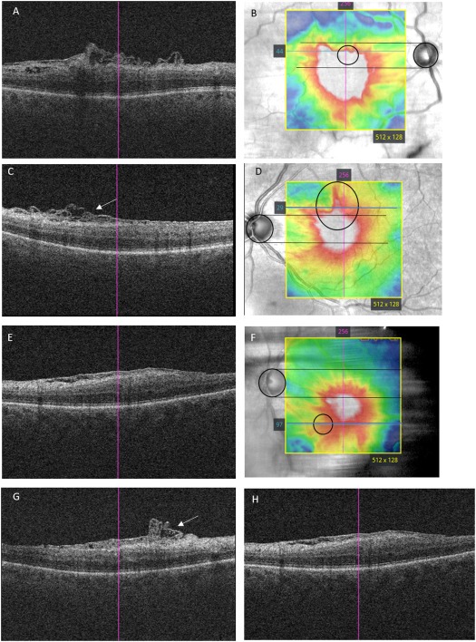Visual, Anatomic Outcomes, and Natural History of Retinal Nerve Fiber Layer Schisis in Patients Undergoing Epiretinal Membrane Surgery ow.ly/yQft50LrM3Q