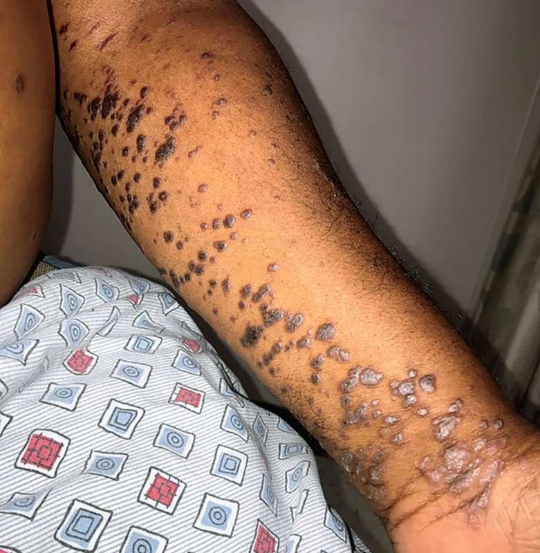 BrownJHM's tweet image. A 69-year-old man with hx of Hepatitis C presented with a 2-month hx of a pruritic rash. The rash first appeared on his right wrist &amp;amp; within 2 weeks had spread to his arms, legs, &amp;amp; trunk. What is the likely diagnosis? #Medtwitter