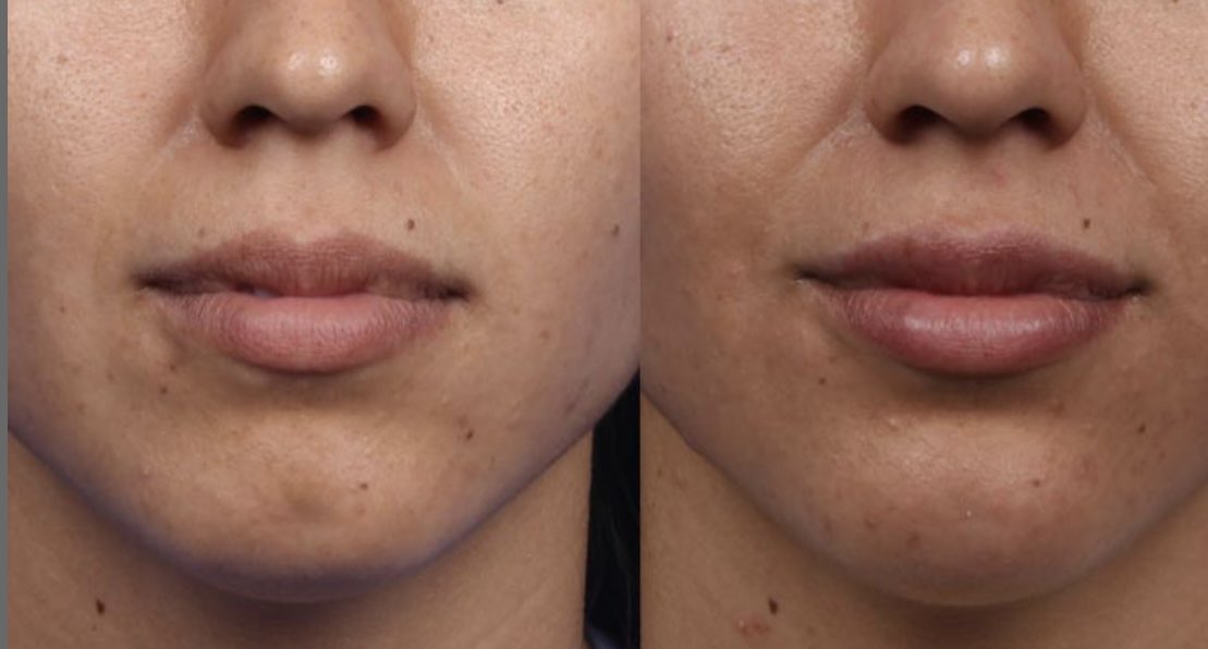 Aesthe1Complete's tweet photo. Before after picture #lipfiller #rejuvenate #fullerlips #fillers #lip-enhancing #fullerlips  #aesthetics #Aylesbure #completeaesthetics https://t.co/W32ThenmEN