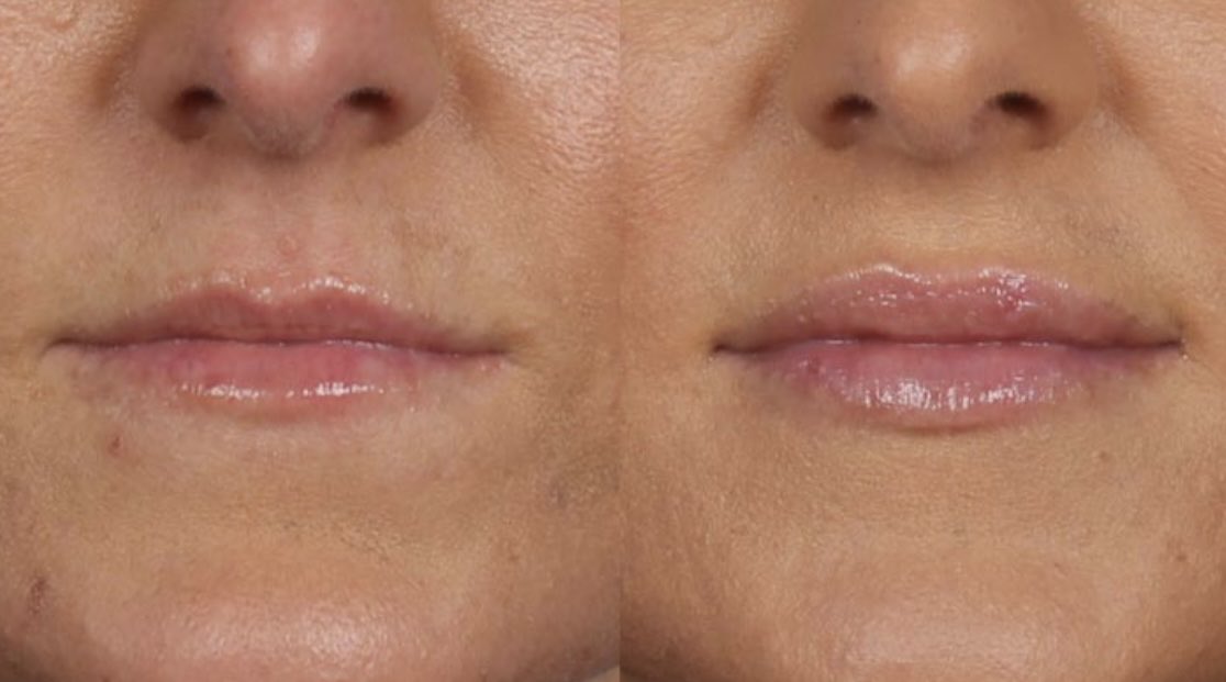 Aesthe1Complete's tweet photo. Before after pic #lipfillers #fullerlips #fillers #rejuvenate #aesthetics #aylesbury #completeaetheticsandbeauty https://t.co/vjQpn6WNsU