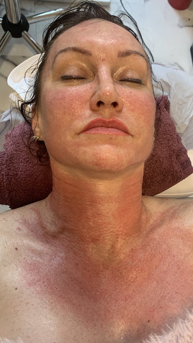 Aesthe1Complete's tweet photo. After #microneedlening treatment #antyaging #skinrejuvenation #fachial https://t.co/SUE8Pnnh64