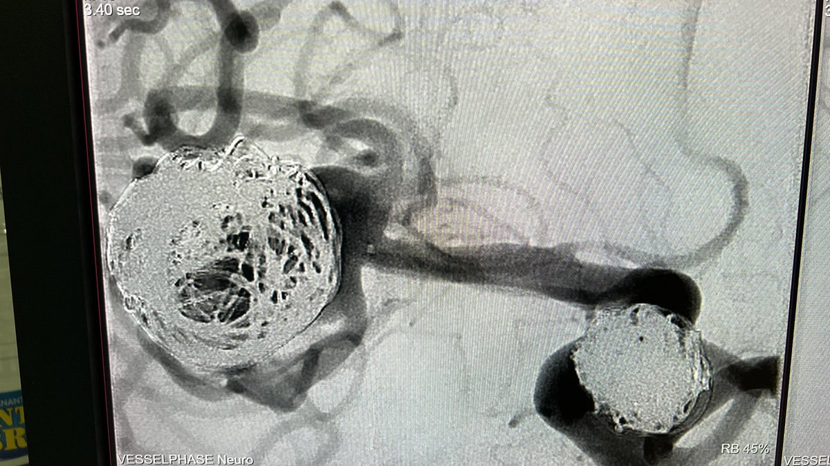 Final result… Waiting for control at three months!!