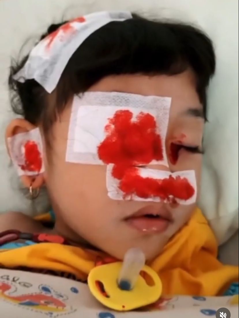 tangankanankuu's tweet photo. 🪄TWITTER PLEASE DO UR MAGIC🪄
Namaku Lula, umurku 4thn. Aku adalah pejuang Bernards Soulier Syndrome,kelainan genetik turunan dgn ketidakmampuan tubuh membekukan darah. Sekarang sedang berjuang u/ sembuh stlh 4 saudaraku meninggal akibat penyakit yg sama- https://t.co/Dt7JbwkFMV