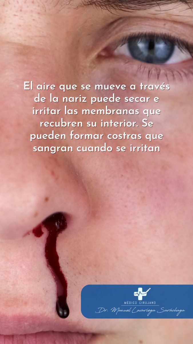 DrLavariega's tweet photo. Las hemorragias nasales pueden tener causas que no se deben a una enfermedad subyacente. Por ejemplo, sequedad nasal, meterse el dedo en la nariz o lesiones https://t.co/aIiIqOpvAX