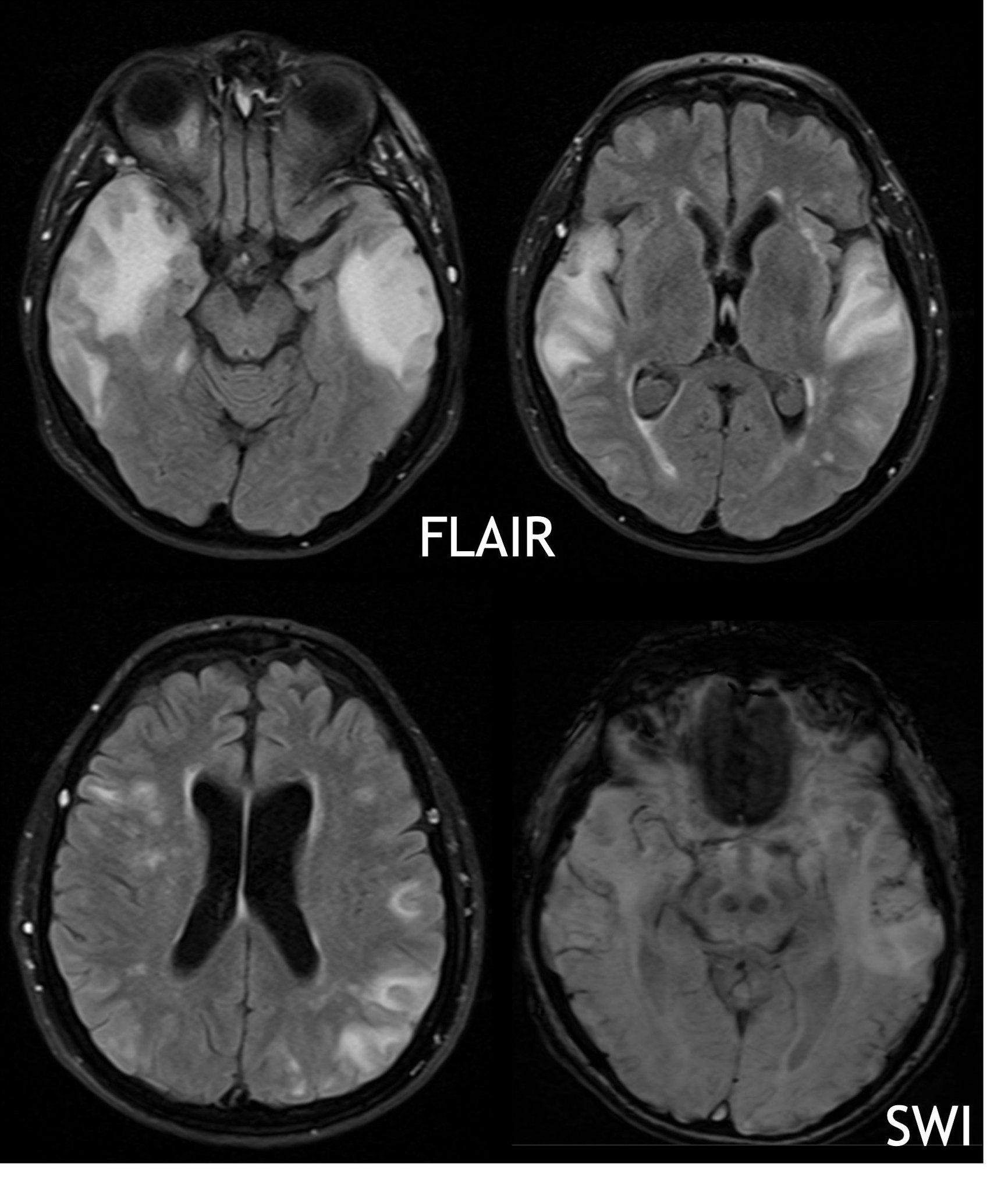 Andreas Charidimou MD, PhD on Twitter "⚡️🚨Patient with mild 