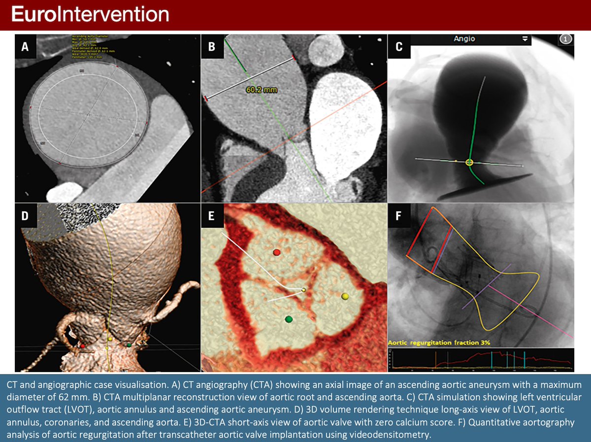 "Transcatheter aortic valve implantation of a novel system for severe pure native aortic regurgitation in a patient with ascending aorta aneurysm". An Interventional Flashlight by Wienemann H, et al. #PCRLV #EAPCI
ow.ly/WtZJ50LMhnA