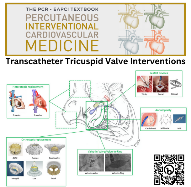 EAPCIPresident's tweet photo. ❓How do you treat Tricuspid Valve disease❓

Enjoy free access to this chapter on Transcatheter Tricuspid Valve Interventions from the PCR-#EAPCI Textbook until 1st December

@nbuzzatti @giuliorus @azeemlatib @drmaisano

🔗 https://t.co/vqmXg26O4M https://t.co/K6xJQvN6Lp