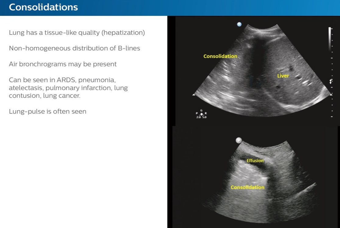 NephroP's tweet photo. Summary of Lung #POCUS 
Courtesy: Philips Healthcare @NikraDoc 
https://t.co/gjV92BHOYo
#IMPOCUS #MedEd https://t.co/3THS4LHDED