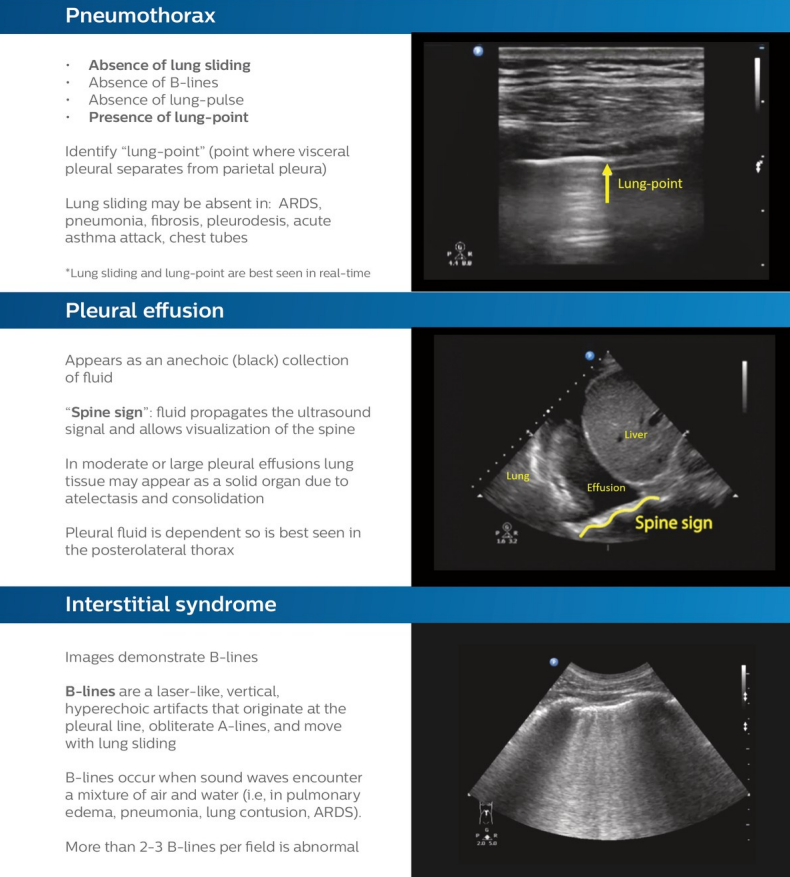 NephroP's tweet photo. Summary of Lung #POCUS 
Courtesy: Philips Healthcare @NikraDoc 
https://t.co/gjV92BHOYo
#IMPOCUS #MedEd https://t.co/3THS4LHDED