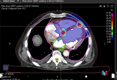 Oncología radioterápica HUPH (@huphradonc) on Twitter photo Our first patient treated with cardiac radioablation at <a href="/HospitalPdH/">Puerta de Hierro</a>.
Cardioablation team: <a href="/JesusRomeroFdez/">Jesús Romero</a> <a href="/ifdezlozano/">IFLozano</a>, Jesus G Mirelis, Ruth Romero, <a href="/Dra_SantanaJ/">Sofía Santana Jiménez</a> , Elena and many more.
Thanks to <a href="/SHohmannMD/">Stephan Hohmann</a> for help with the registration process.
Hopeful with the results. Our first patient treated with cardiac radioablation at <a href="/HospitalPdH/">Puerta de Hierro</a>.
Cardioablation team: <a href="/JesusRomeroFdez/">Jesús Romero</a> <a href="/ifdezlozano/">IFLozano</a>, Jesus G Mirelis, Ruth Romero, <a href="/Dra_SantanaJ/">Sofía Santana Jiménez</a> , Elena and many more.
Thanks to <a href="/SHohmannMD/">Stephan Hohmann</a> for help with the registration process.
Hopeful with the results.