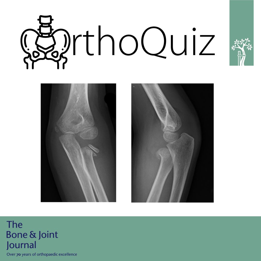 The Bone & Joint Journal tweet media