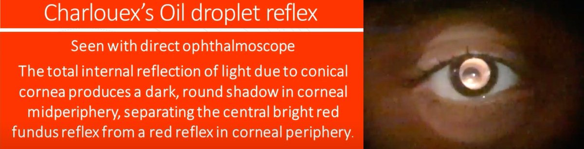 revoptom's tweet photo. Annular Dark Shadow Assessment Useful in Diagnosing Keratoconus
The height of the finding was significantly correlated with keratoconus severity, study shows.
https://t.co/qIExf5KL77
#keratoconus #cornea #eyecare #optometr https://t.co/7vL24Xzqo9