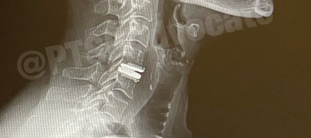 PTSDAdvocate's tweet photo. @stevero40104467 @JoeAllenNewman @SaraGedda2 @Isaac38873436 @CMerandi Yes, cervical disc replacement relieved 90% of pain. I went to #TexasBackInstitute who pioneered this type of disc. They do lumbar disc replacement, but discitis after an ESI ate away too much bone. It would cause more damage than harm.
Tarlov Cysts👇
https://t.co/YHygVBDvKb https://t.co/WEVRN6NcZU