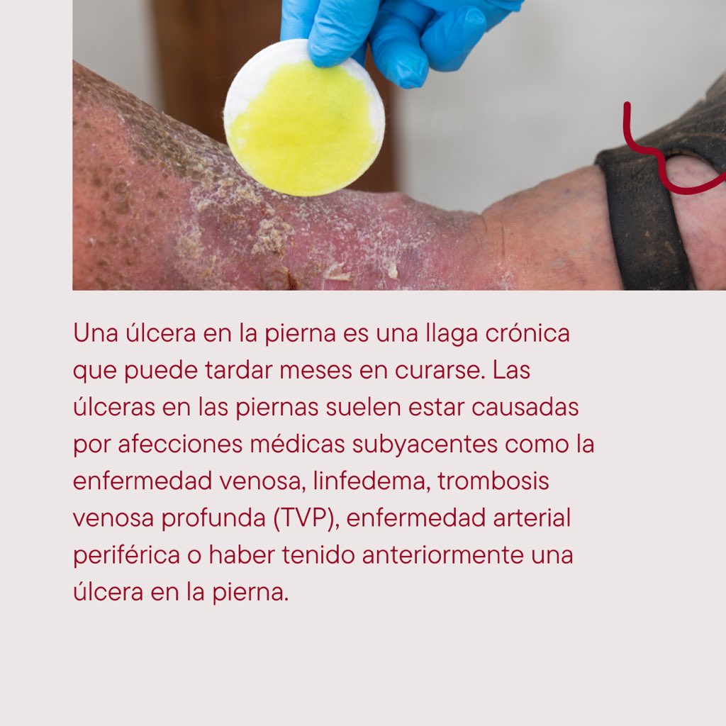 SDVascular's tweet photo. Las úlceras de la pierna son heridas abiertas en la piel que aparecen por debajo de la rodilla, generalmente porque el flujo sanguíneo es deficiente en la parte inferior de la pierna.

Algunas cosas que debes saber sobre ellas, en este post. 
#SDCVE https://t.co/uWzrA2syWD