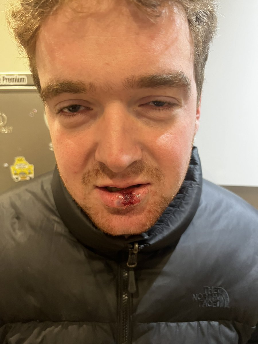 AlfieFarr21's tweet photo. The things you do for the game of football- a stunning display of ten minutes before a clash took @freddiehastone to AandE for 11 stitches #aande #football #primobagno #worldcup #messi https://t.co/J8Z8pUmdGf