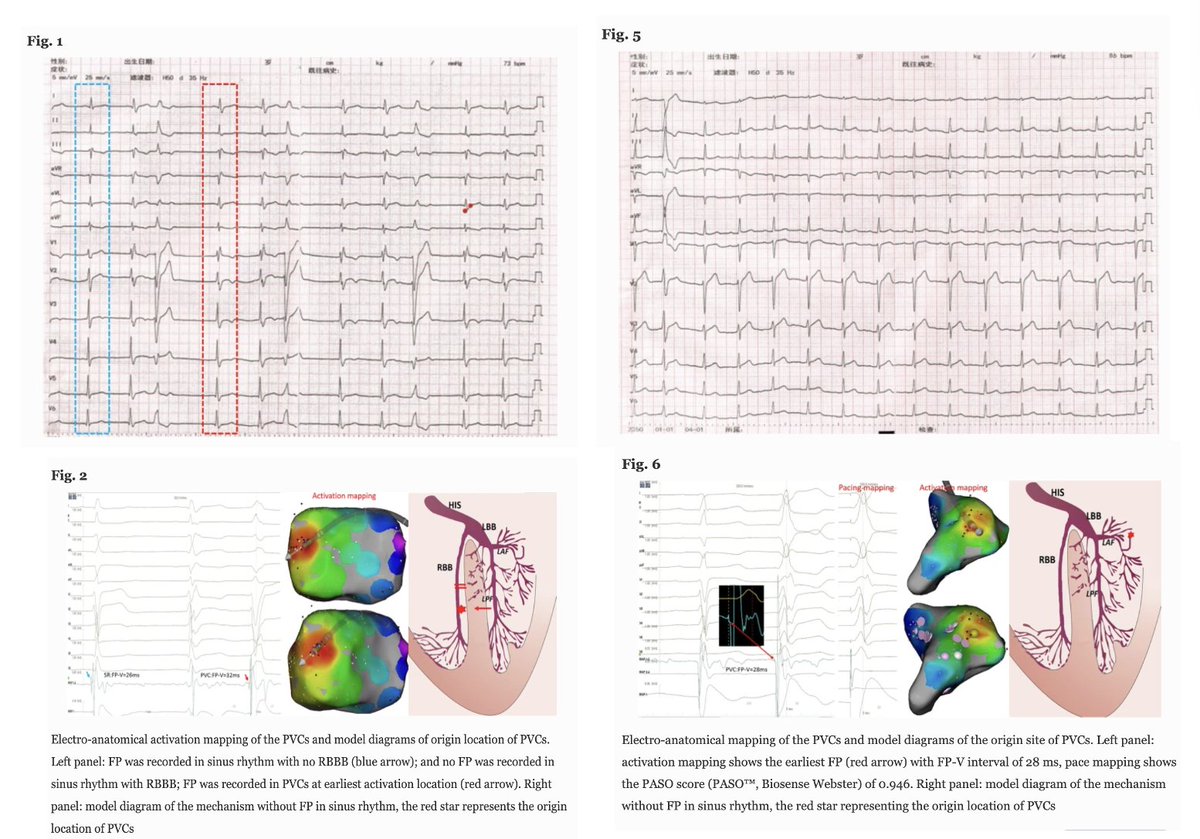 JICE_EP's tweet photo. 🚨Latest #OpenAccess Article in
@JICE_EP
Clinical observations of RF ablation for PVCs originating from uncommon His-Purkinje sites
by J Huang, Y Zhao, L Yang, & Q Liu
📖🧐 #OpenAccess: https://t.co/yhFcwnxWKT
#EPeeps
#Cardiotwitter
#Ablate VT https://t.co/KASAnxpy8P