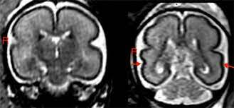 Addiction_22's tweet photo. Drinking during pregnancy changes baby's brain structure https://t.co/Ese4uV9dDH https://t.co/zuSGDMvPfT