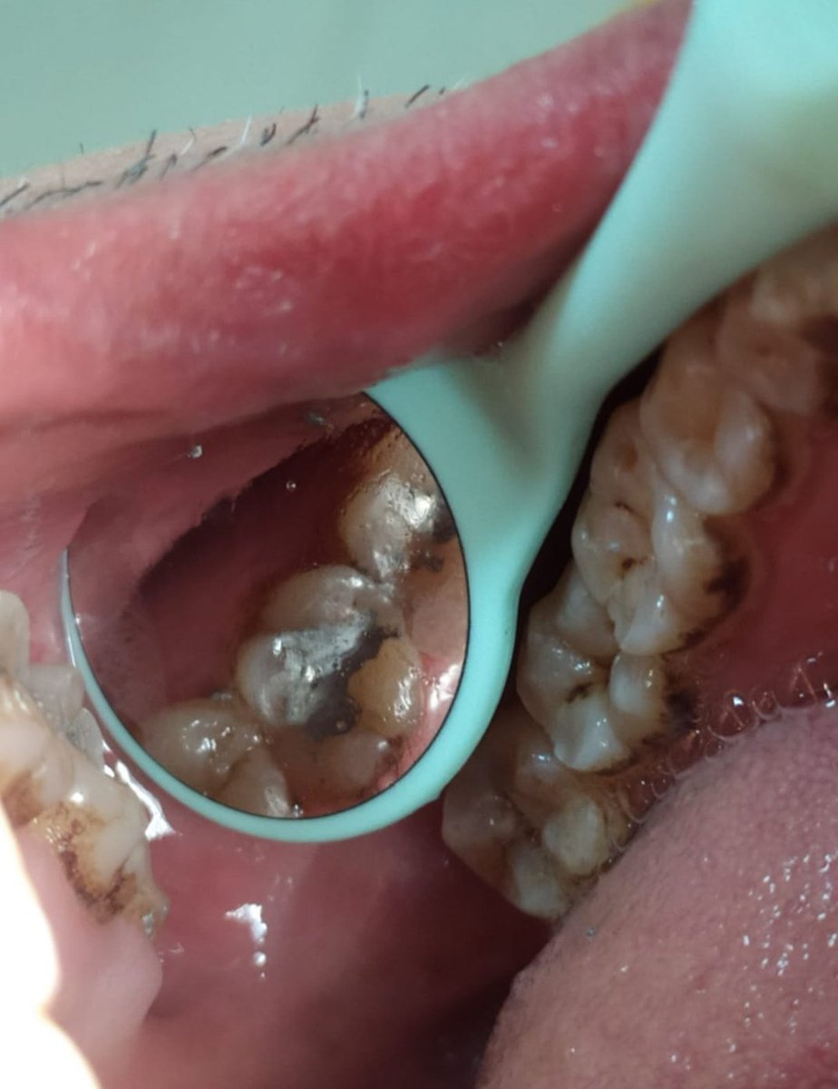 Mahmoudkhatab77's tweet photo. الحمد لله...💕
My frist clinical case .
Amalgam restoration for upper 7 , indirect technica. I know it's not the best , but I hope the next be better. https://t.co/y8weWFWoZZ