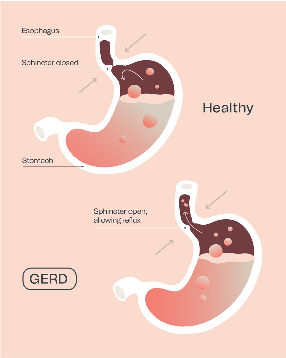GERD is diagnosed by judging the frequency of symptoms like #acidreflux when stomach acid flows back into the #esophagus (your food tube if you will). See our illustration of a #healthy stomach and one with #GERD.