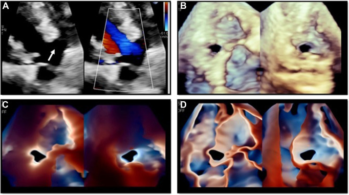 Clinical Utility of Transillumination on Transthoracic Imaging @CASEfromASE Juan I. Cotella et al. @robertomlang bit.ly/3EVPyo0 @denisamuraru @lpbadano @DonalErwan @dr_benoy_n_shah @iamritu @drzgezdentok1 @NMerke @GE_IanMc @papadocardio @leylaelifsade @AJamilTajik