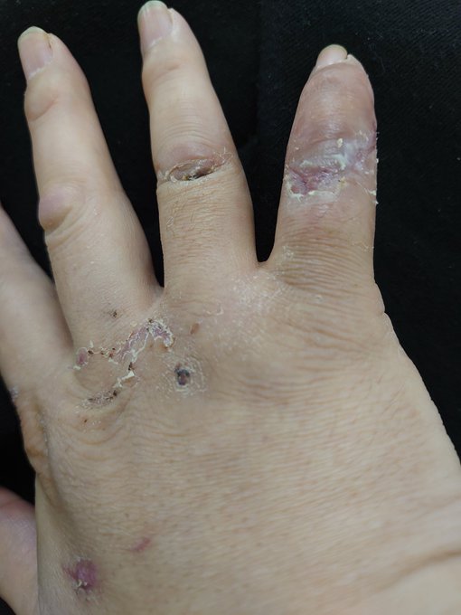 大分良くなったん(気がする)で自己判断でギブス取って作業進めてて、ドヤ顔で医者行ったらアホかー腫れとるやんけと叱られてしまった、、

うーん確かに、、

いやだって包帯とか巻かれてると描けないし😭 