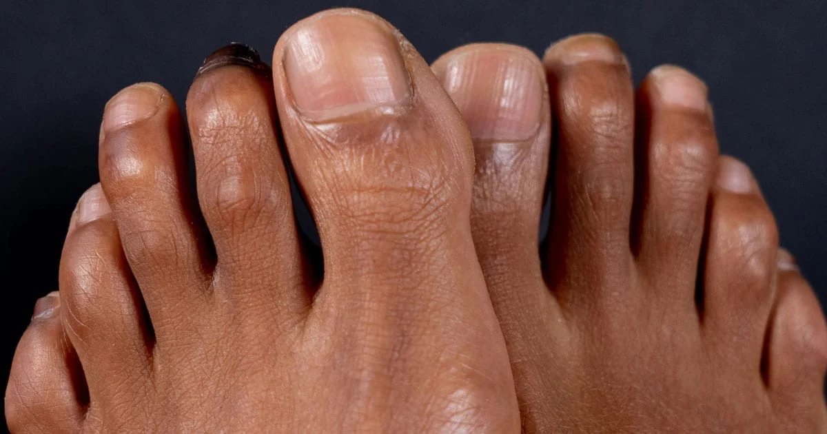 Associated Foot Care Clinic on Twitter "Hammertoes and mallet toes are