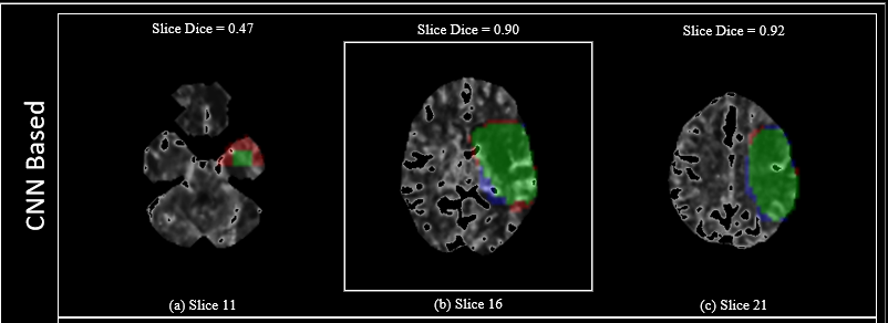 OleaMedical's tweet photo. #RSNA2022 Be there for the poster presentation of the abstract on 'Enhancing segmentation of infarct and penumbra tissue on CT Perfusion using deep learning' at RSNA 2022! 

🗓 November 30, 2022  
⏰ 12:15 - 12:45 
📍 Learning Center - NR DPS - W5A-SPNR-1
#radiology #CTperfusion https://t.co/WD5S5VCXgJ