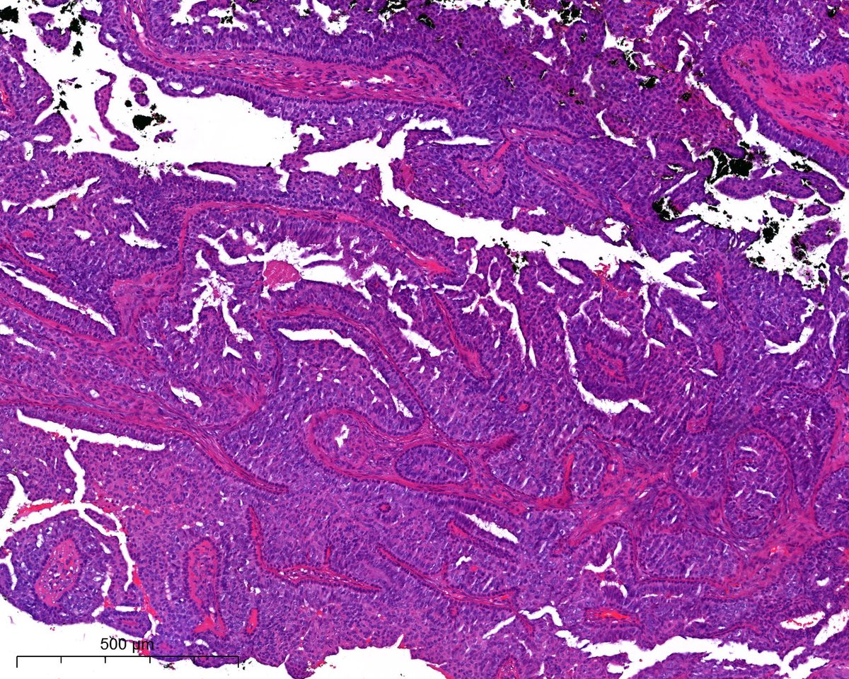 A. Polónia (@poloniaantonio) on Twitter photo Young F with nipple discharge #breastpath <a href="/atman_ci/">Dr. Luca</a> <a href="/ADamronMD/">Alexander Damron, MD</a> <a href="/LizaMQuintana/">Liza Quintana, MD</a> <a href="/AGrabenstetter/">Anne Grabenstetter</a> <a href="/DrGeeONE/">Olaleke Folaranmi</a> <a href="/tlabiano/">Tania Labiano</a> <a href="/AmPathology/">Ana Marques</a> <a href="/jennpincus/">Jenny Pincus, MD</a> <a href="/ariella8/">Celina Stayerman MD</a> <a href="/nusrat_xahra/">🔻Nusrat Zahra🔻🇵🇸</a> @miss_me1986 <a href="/gonzadetoro/">Gonzalo De Toro</a> <a href="/TristanRutland7/">Tristan Rutland MBBS FRCPA IFCAP</a> <a href="/LoboAnandi/">Anandi Lobo, MD</a> <a href="/SumantaDas_7/">Sumanta Das</a> <a href="/israhkhan/">Israh Akhtar Khan</a> <a href="/kis_lorand/">Lorand Kis</a> <a href="/Cristina_VargAP/">A. Cristina Vargas</a> Young F with nipple discharge #breastpath <a href="/atman_ci/">Dr. Luca</a> <a href="/ADamronMD/">Alexander Damron, MD</a> <a href="/LizaMQuintana/">Liza Quintana, MD</a> <a href="/AGrabenstetter/">Anne Grabenstetter</a> <a href="/DrGeeONE/">Olaleke Folaranmi</a> <a href="/tlabiano/">Tania Labiano</a> <a href="/AmPathology/">Ana Marques</a> <a href="/jennpincus/">Jenny Pincus, MD</a> <a href="/ariella8/">Celina Stayerman MD</a> <a href="/nusrat_xahra/">🔻Nusrat Zahra🔻🇵🇸</a> @miss_me1986 <a href="/gonzadetoro/">Gonzalo De Toro</a> <a href="/TristanRutland7/">Tristan Rutland MBBS FRCPA IFCAP</a> <a href="/LoboAnandi/">Anandi Lobo, MD</a> <a href="/SumantaDas_7/">Sumanta Das</a> <a href="/israhkhan/">Israh Akhtar Khan</a> <a href="/kis_lorand/">Lorand Kis</a> <a href="/Cristina_VargAP/">A. Cristina Vargas</a>