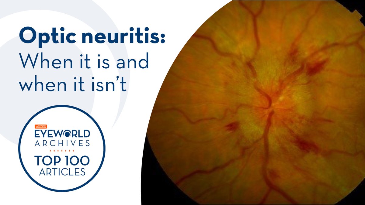 Optic neuritis or not? This EyeWorld archived article gives pearls to accurately diagnose the condition bit.ly/2YrMjSX#EyeWor… #ThrowbackThursday