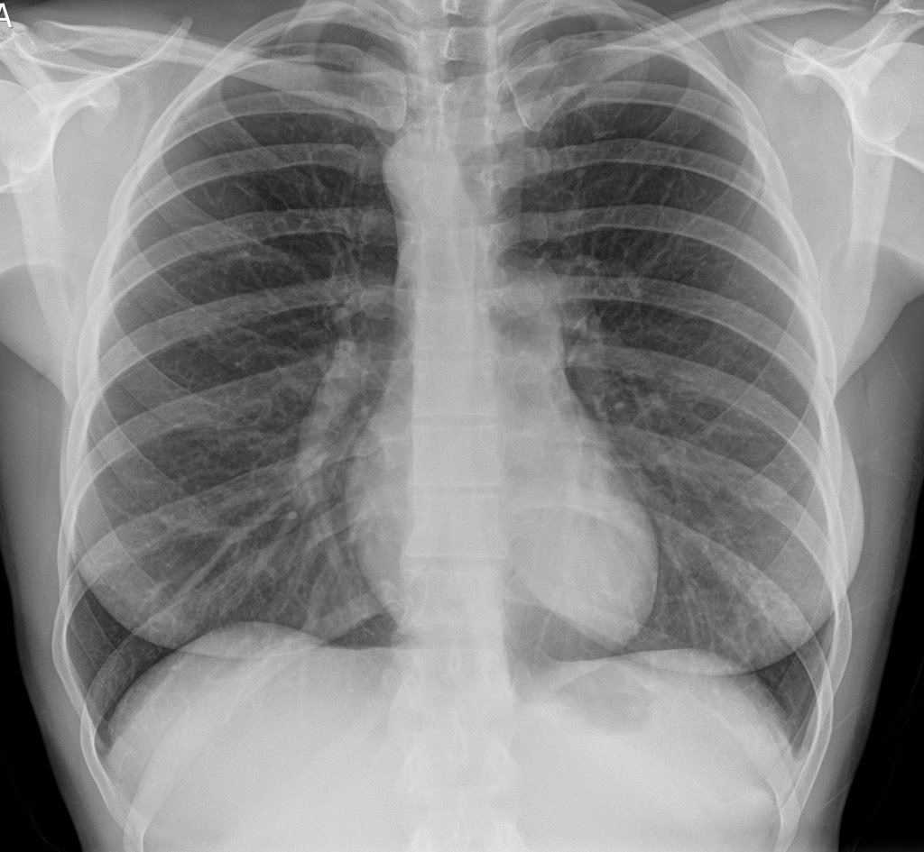BrownJHM's tweet image. A 40 year old female presented with cough. What anatomical variant is noticed in the X-ray? (Image @Radiopaedia, case by Dr. Ian Bickle) #Medtwitter