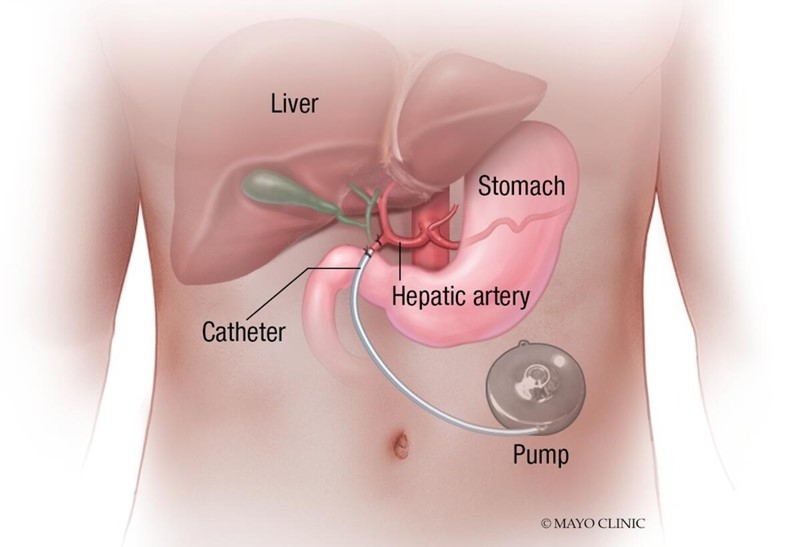 Mayo Clinic Department of Surgery (@mayoclinicsurg) on Twitter photo A team of surgery & oncology experts at <a href="/MayoClinic/">Mayo Clinic</a> are using hepatic artery infusion pump chemotherapy in select patients, providing a liver-directed treatment option for patients who previously had none. Learn more: mayocl.in/3V6eejk <a href="/MayoCancerCare/">Mayo Clinic Comprehensive Cancer Center</a> <a href="/ThielsCA/">Cornelius A. Thiels</a> @drsuswarner A team of surgery & oncology experts at <a href="/MayoClinic/">Mayo Clinic</a> are using hepatic artery infusion pump chemotherapy in select patients, providing a liver-directed treatment option for patients who previously had none. Learn more: mayocl.in/3V6eejk <a href="/MayoCancerCare/">Mayo Clinic Comprehensive Cancer Center</a> <a href="/ThielsCA/">Cornelius A. Thiels</a> @drsuswarner