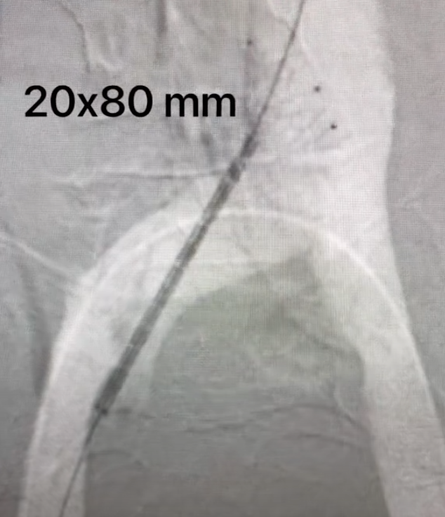HadyLichaaMD's tweet photo. #NIVLstenting w #BilateralVenogramRoadmap from 1 access only

A life changing procedure

https://t.co/ZkLRj6Sbz3

@ashkan_1670 @EricSecemskyMD @kerrigjl  @DrJayMohan @drochohan @NickMouawadMD @farkomd @mirvatalasnag @aayshacader @PCRonline  @BagaiJayant @haseebqazi @Vascupedia1 https://t.co/FVIQr8cmEw