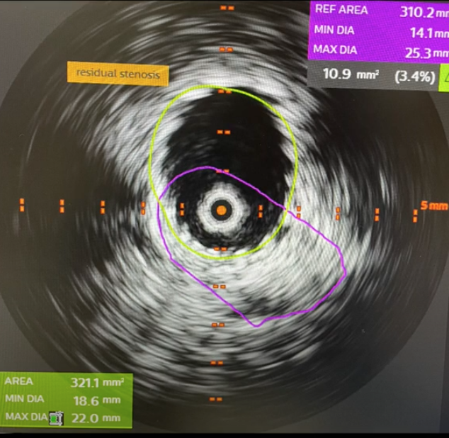 HadyLichaaMD's tweet photo. #NIVLstenting w #BilateralVenogramRoadmap from 1 access only

A life changing procedure

https://t.co/ZkLRj6Sbz3

@ashkan_1670 @EricSecemskyMD @kerrigjl  @DrJayMohan @drochohan @NickMouawadMD @farkomd @mirvatalasnag @aayshacader @PCRonline  @BagaiJayant @haseebqazi @Vascupedia1 https://t.co/FVIQr8cmEw