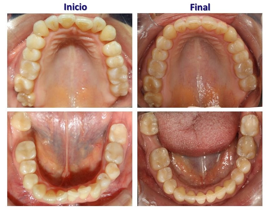 RaulEcheverriaQ's tweet photo. Excelentes resultados en un paciente adulto con el sistema INVISALIGN 👌🏻👏🏻!!! Seguimos con nuestro Invisalign WEEK!🎊

#elsalvador #invisaling https://t.co/wXVvOm4ibg