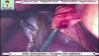 DrATEFAHMED's tweet photo. #Laparoscopic_Cholecystectomy 

https://t.co/tKuMtUaX5Q
https://t.co/sHUrJugpsM

#laparoscopiccholecystectomy 
#laparoscopic  #cholecystectomy 
#bleeding #perforation 
#laparoscopicsurgery #surgeon  #doctor 
#anatomy #surgicalanatomy #surgery #mrcs 
#frcs #usmle  
#Anatomy https://t.co/5tYKILpi7m