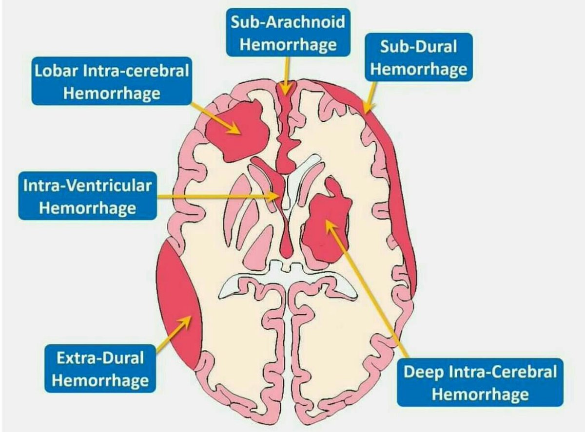 The Innovation Medicine on Twitter "Types of brain haemorrhage 