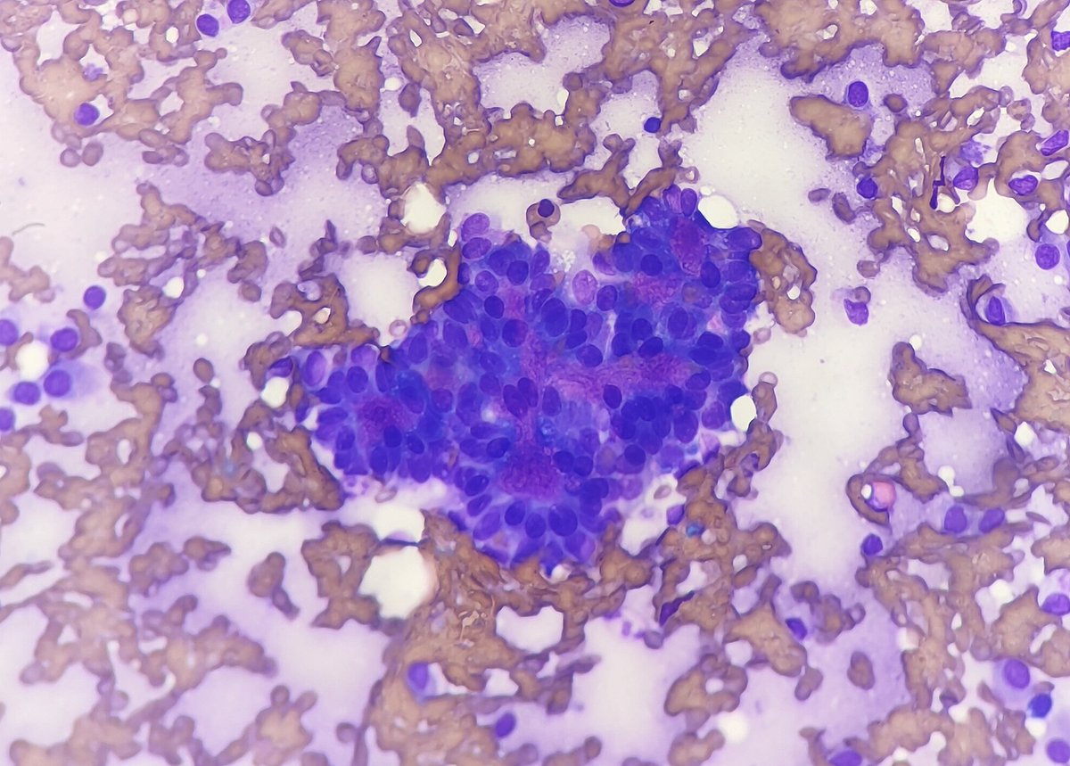 Quique_rs's tweet image. Female 75 yo with parotid gland tumor. Monotonous plasmocytoid cells with metachromatic extracellular material. 
Cellular pleomorphic adenoma, basal cell adenoma, myoepithelioma, SUMP?  #cytopath