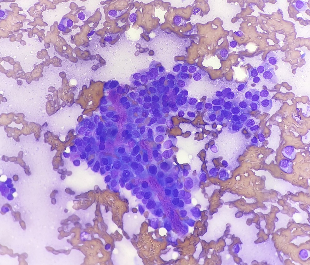 Quique_rs's tweet image. Female 75 yo with parotid gland tumor. Monotonous plasmocytoid cells with metachromatic extracellular material. 
Cellular pleomorphic adenoma, basal cell adenoma, myoepithelioma, SUMP?  #cytopath