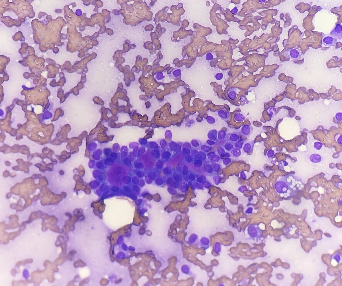 Quique_rs's tweet image. Female 75 yo with parotid gland tumor. Monotonous plasmocytoid cells with metachromatic extracellular material. 
Cellular pleomorphic adenoma, basal cell adenoma, myoepithelioma, SUMP?  #cytopath