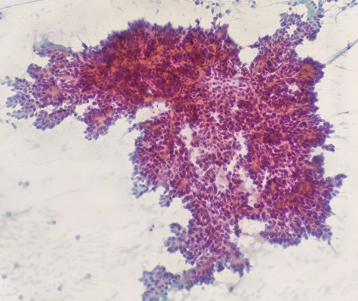 Quique_rs's tweet image. Female 75 yo with parotid gland tumor. Monotonous plasmocytoid cells with metachromatic extracellular material. 
Cellular pleomorphic adenoma, basal cell adenoma, myoepithelioma, SUMP?  #cytopath
