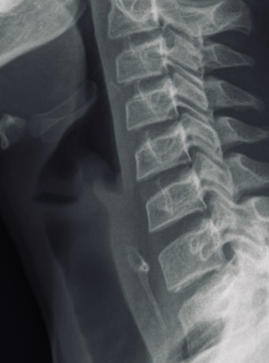 radRounds's tweet photo. Quiz: patient rushed from #thanksgiving dinner to ER w difficulty swallowing and neck pain. Diagnosis?  (Hint and Lesson: eat slowly!) #MedTwitter #radtwitter #radiology #MedStudentTwitter #meded #foamrad https://t.co/UgA7zpQ1r7