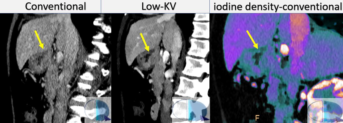 <a href="/CtSpectral/">Gopal Punjabi</a> Companion case seen the other day at <a href="/RMyTC_Rosario/">RM y TC Rosario</a>. Posterior gastric ulcer in a proven gastric neoplasm, better seen in the low-KV images and in the iodine overlay than on the conventional images. <a href="/eliseovano/">Eliseo Vañó</a> <a href="/CastellaccioDr/">Antonio Castellaccio</a> #FOAMed #SpectralCT